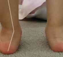 Valgus stopala deformacija pri otrocih
