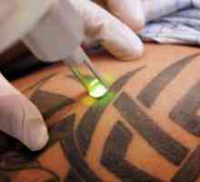 Umik tetovaže