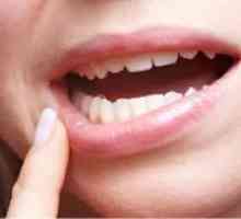 Bolezni ustne sluznice