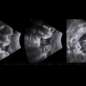 31 Tednov noseče - ultrazvočni standardi