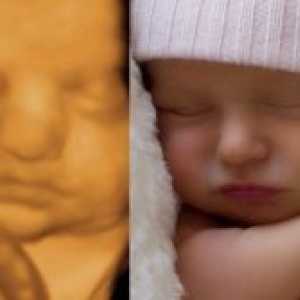 4D ultrazvok v nosečnosti
