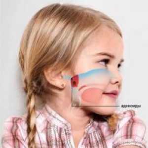 2 Nosnih polipov stopnja pri otrocih