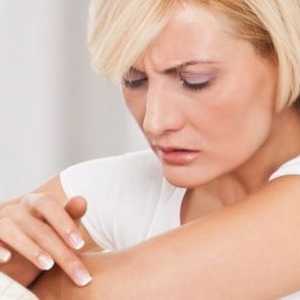 Atopijski dermatitis - simptomi in zdravljenje pri odraslih