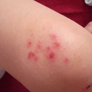 Atopijski dermatitis pri otrocih