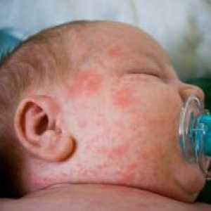Alergije pri dojenčkih