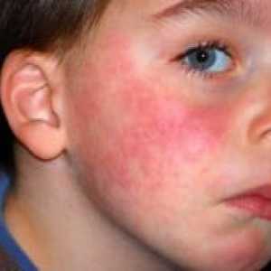 Alergije pri otrocih - kako ravnati?