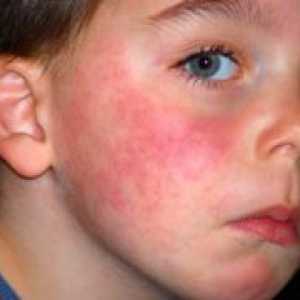 Simptomi alergije pri otrocih
