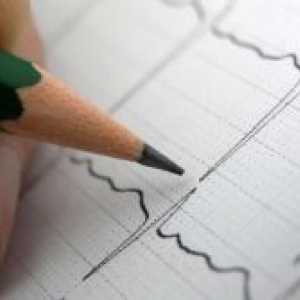 Srčne aritmije - Vzroki in simptomi