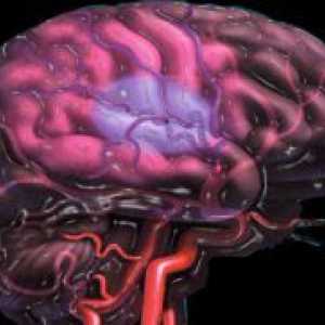 Možganska ateroskleroza - Simptomi
