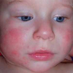 Atopijski dermatitis pri otrocih - Zdravljenje
