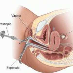 Endometrija biopsija