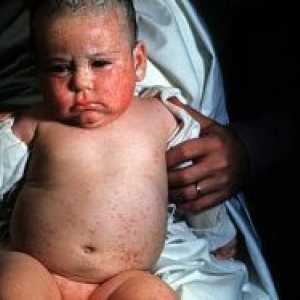 Okužba s citomegalovirusom pri otrocih - Zdravljenje