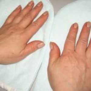 Dermatitis - Simptomi in zdravljenje