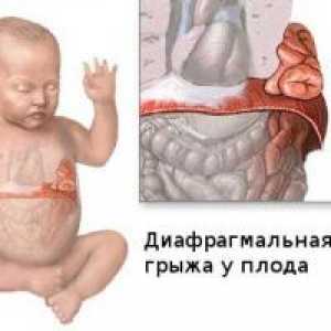 Preponska kila pri novorojenčkih