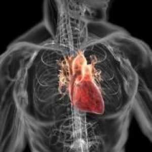 Dilatativna kardiomiopatija