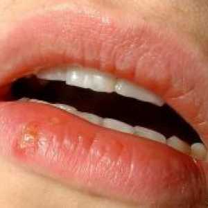Herpes na ustnicah otroka