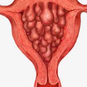 Hiperplazija endometrija - kaj je to?