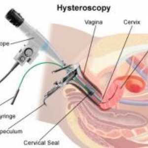 Histeroskopija - posledice
