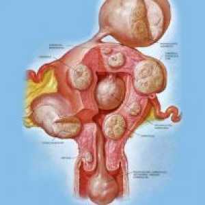 Skupni notranji fibroidi