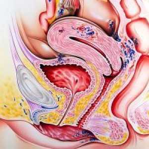 Črevesna Endometrioza - Simptomi