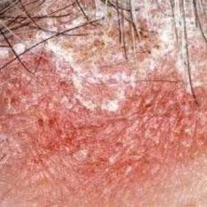 Seborrhea lasišča - najbolj učinkovite metode zdravljenja