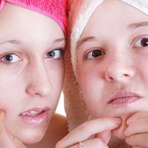 Kako se znebiti najstniških akne
