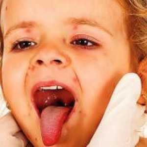 Kako za zdravljenje herpes v grlu otroka?