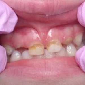 Karies mlečnih zob