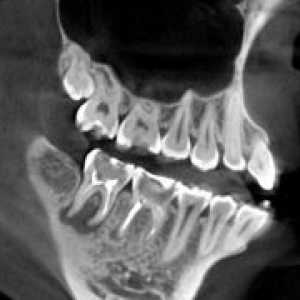 Računalniška tomografija zobje