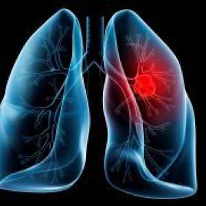 Zdravljenje pljučnega raka folk pravna sredstva