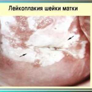 Materničnega vratu levkoplakije - Simptomi