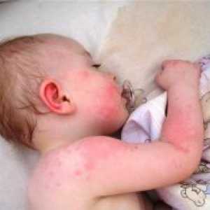 Mazilo z alergijami, za otroke