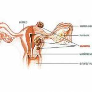 Fibroidi majhnost