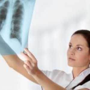 Goriščna pulmonalne tuberkuloze