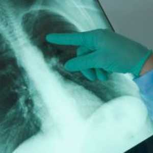 Plevritis pljučnega raka pri