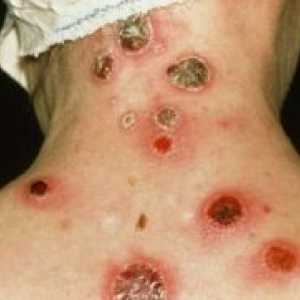Simptomi sifilisa pri ženskah