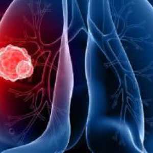 Rak bronhijev - Simptomi