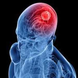 Brain Cancer - Simptomi