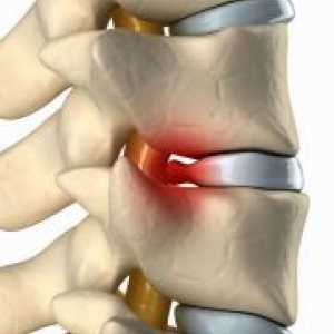Rak hrbtenice - Simptomi in znaki