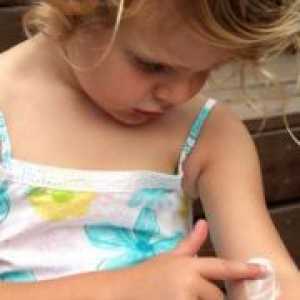 Pink zoster pri otrocih - Zdravljenje