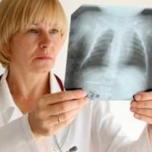 Sarkoidoza pljuč - simptomi