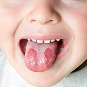 Stomatitis pri otrocih