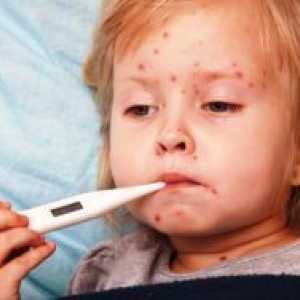 Streptoderma pri otrocih - zdravila za zdravljenje