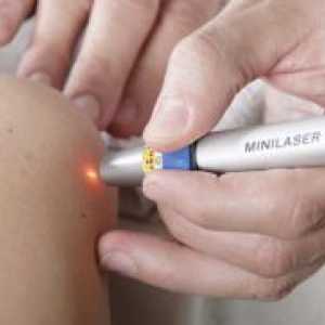Odstranitev papilome laser - učinki