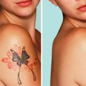 Odstranitev Tattoo laser