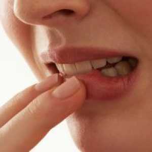 Vnetje dlesni okoli zoba