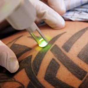 Umik tetovaže