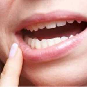 Bolezni ustne sluznice