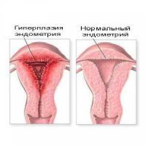 Glandularna hiperplazija endometrija